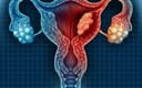 Cảnh báo sớm: 7 dấu hiệu chung của 5 loại ung thư phụ khoa phụ nữ tuyệt đối không nên bỏ qua