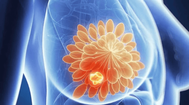 Không đau, không dấu hiệu: 8 ca ung thư lộ diện sau 3 ngày khiến nhiều người giật mình