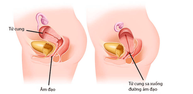 Sa sinh dục là gì? Dấu hiệu nhận biết và cách điều trị hiệu quả cho phụ nữ